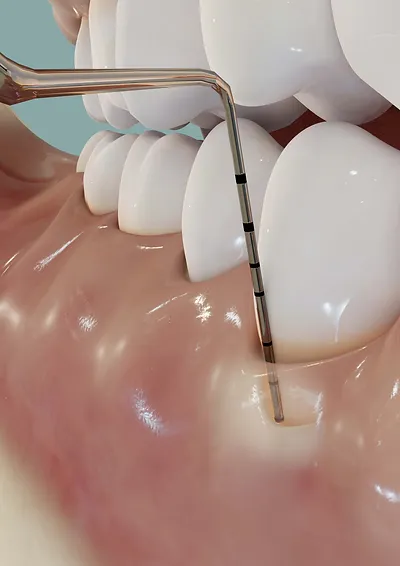 gum-disease-periodontal-probe.png